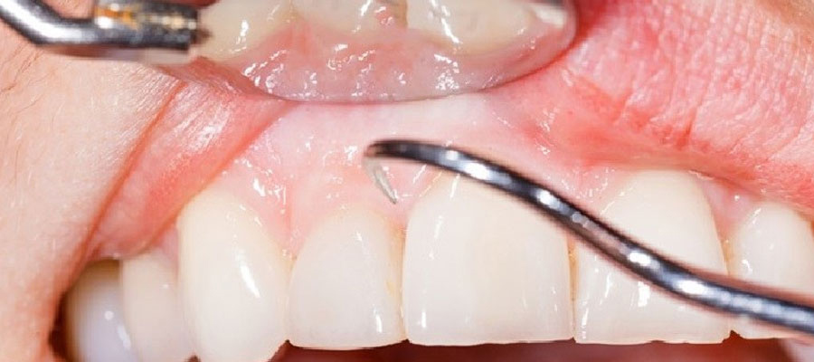 Periodoncia en Murcia